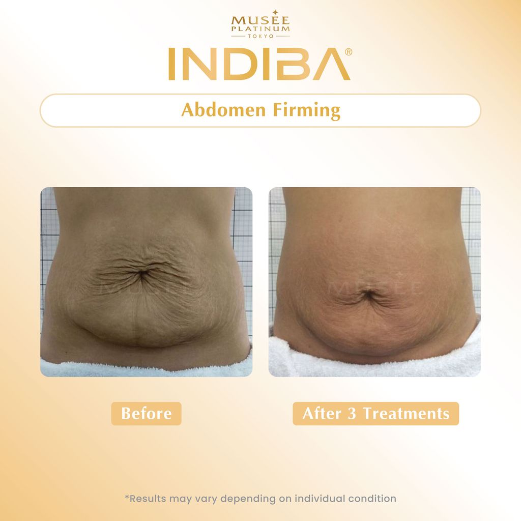 01. Testimonial_Indiba-01