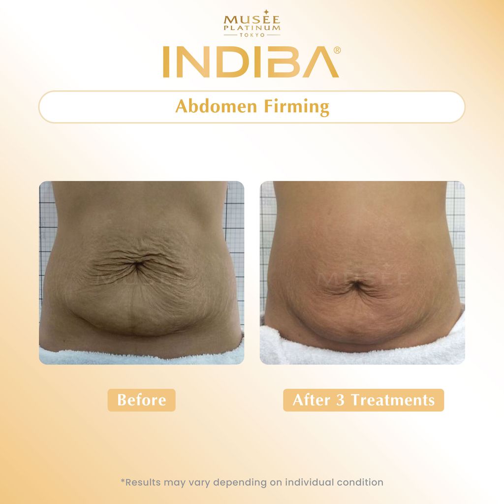 01. Testimonial_Indiba-01