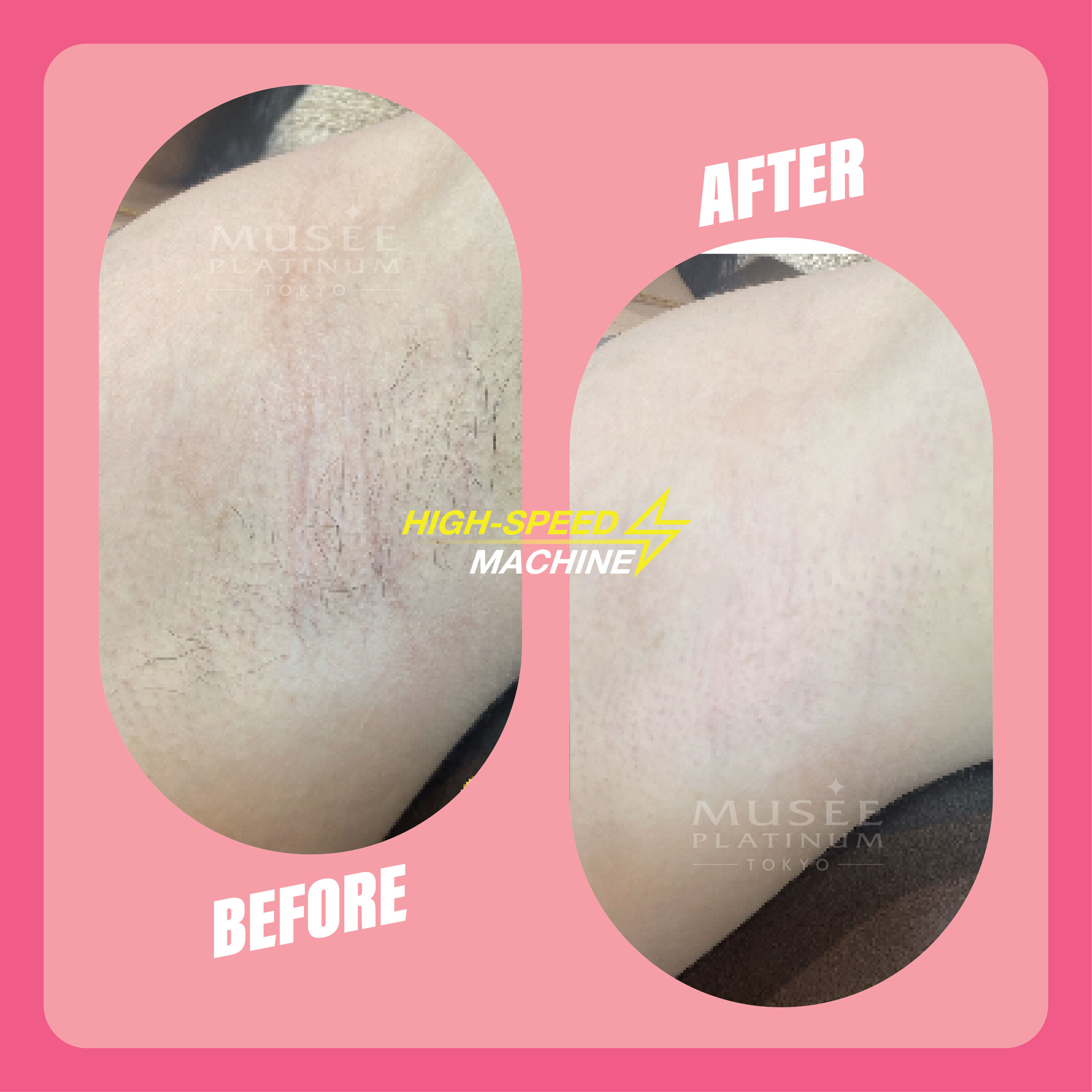 $50 Mix & Match - 6 Parts S.S.C. Hair Removal Package – Musee