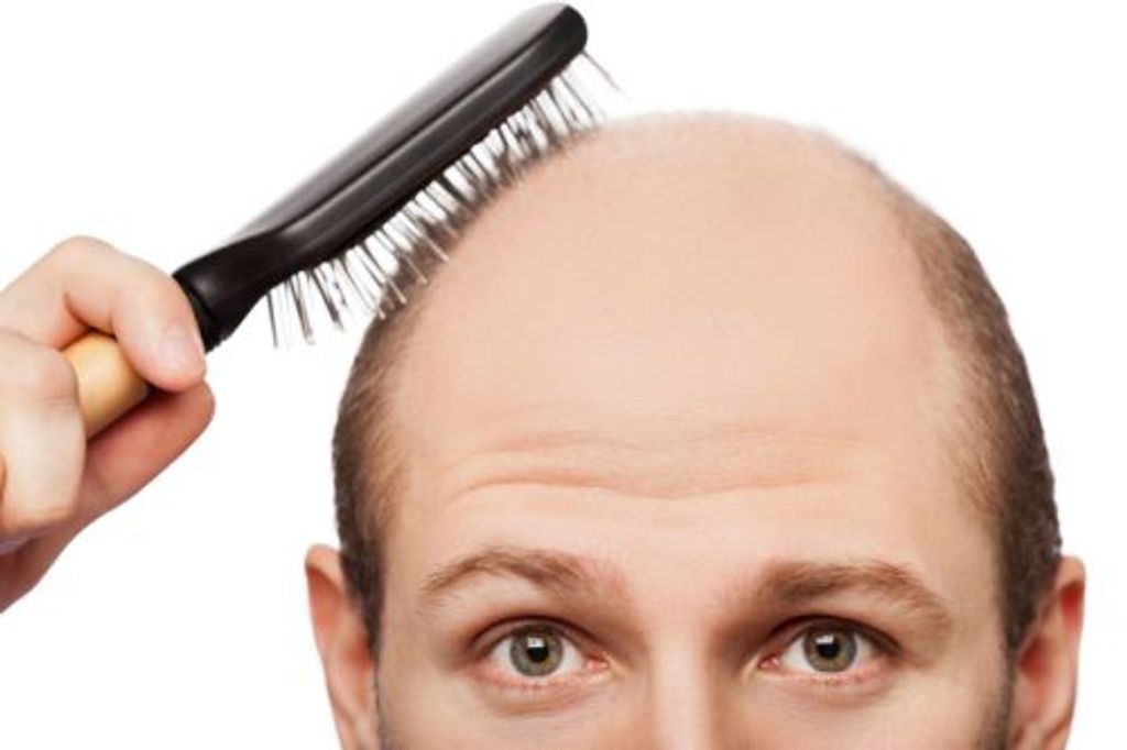Know what is Male Pattern Baldness