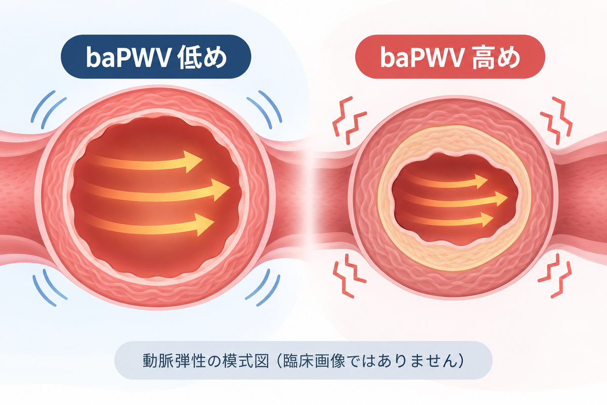 動脈の弾性の模式図：baPWV が低い場合と高い場合の比較