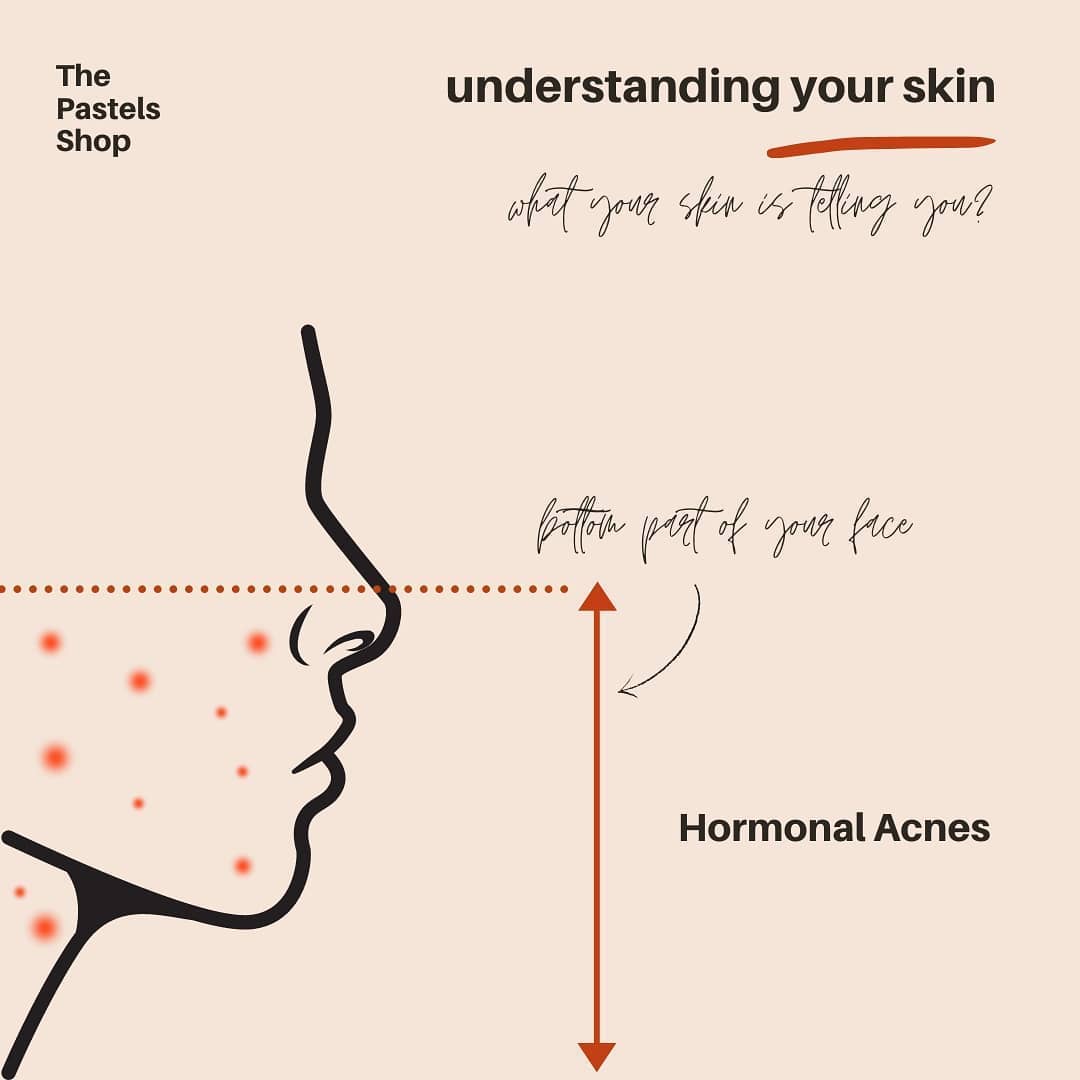 Understanding Your Skin (Hormonal Acne)