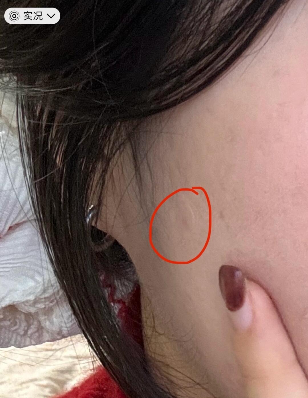 普通人的好物分享10｜隐形痘痘贴_3_ㅎㅈㅎ_来自小红书网页版