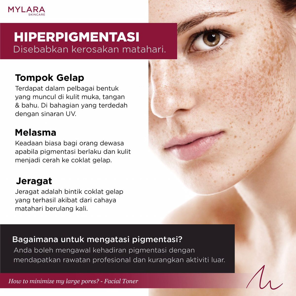 Hiperpigmentasi Mylara Skincare