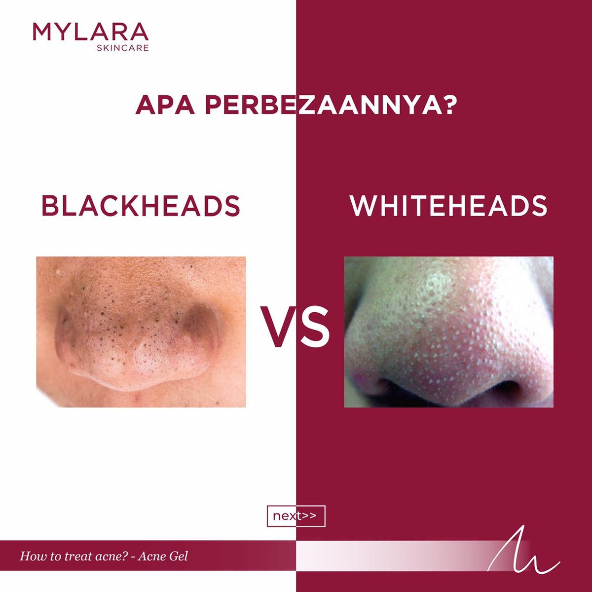BLACKHEAD VS WHITEHEAD