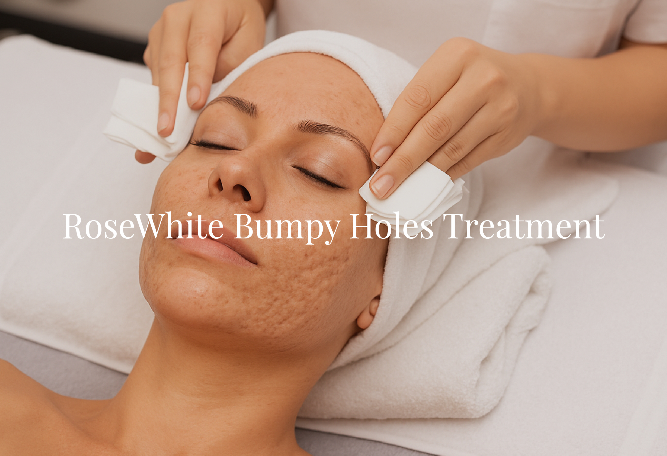 RoseWhite Bumpy Holes Treatment