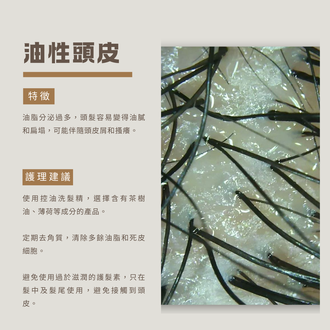 油性頭皮