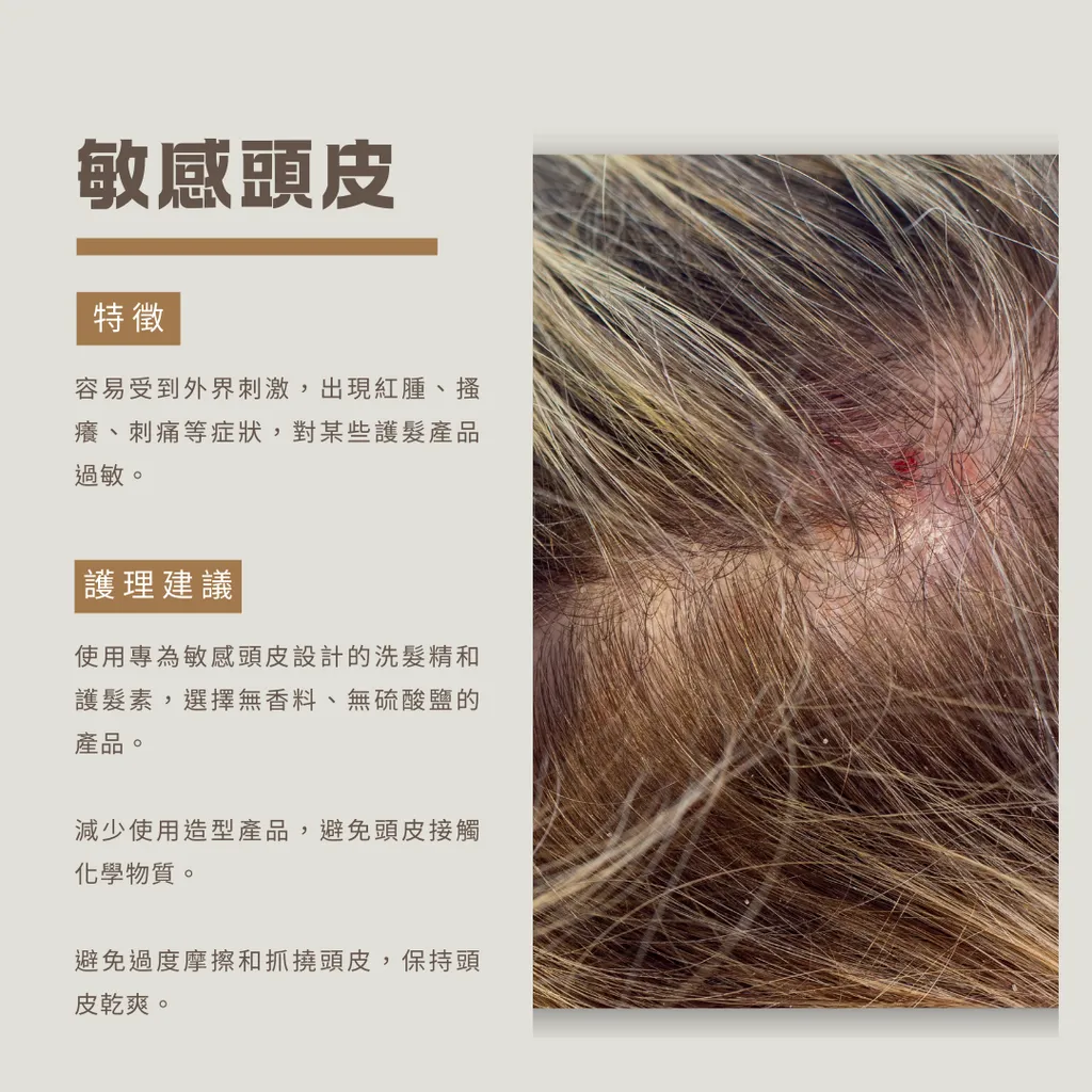 敏感頭皮