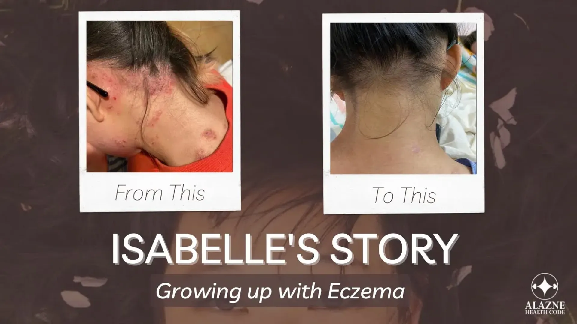 ✦Isabelle's Story: Growing up with Eczema ✦