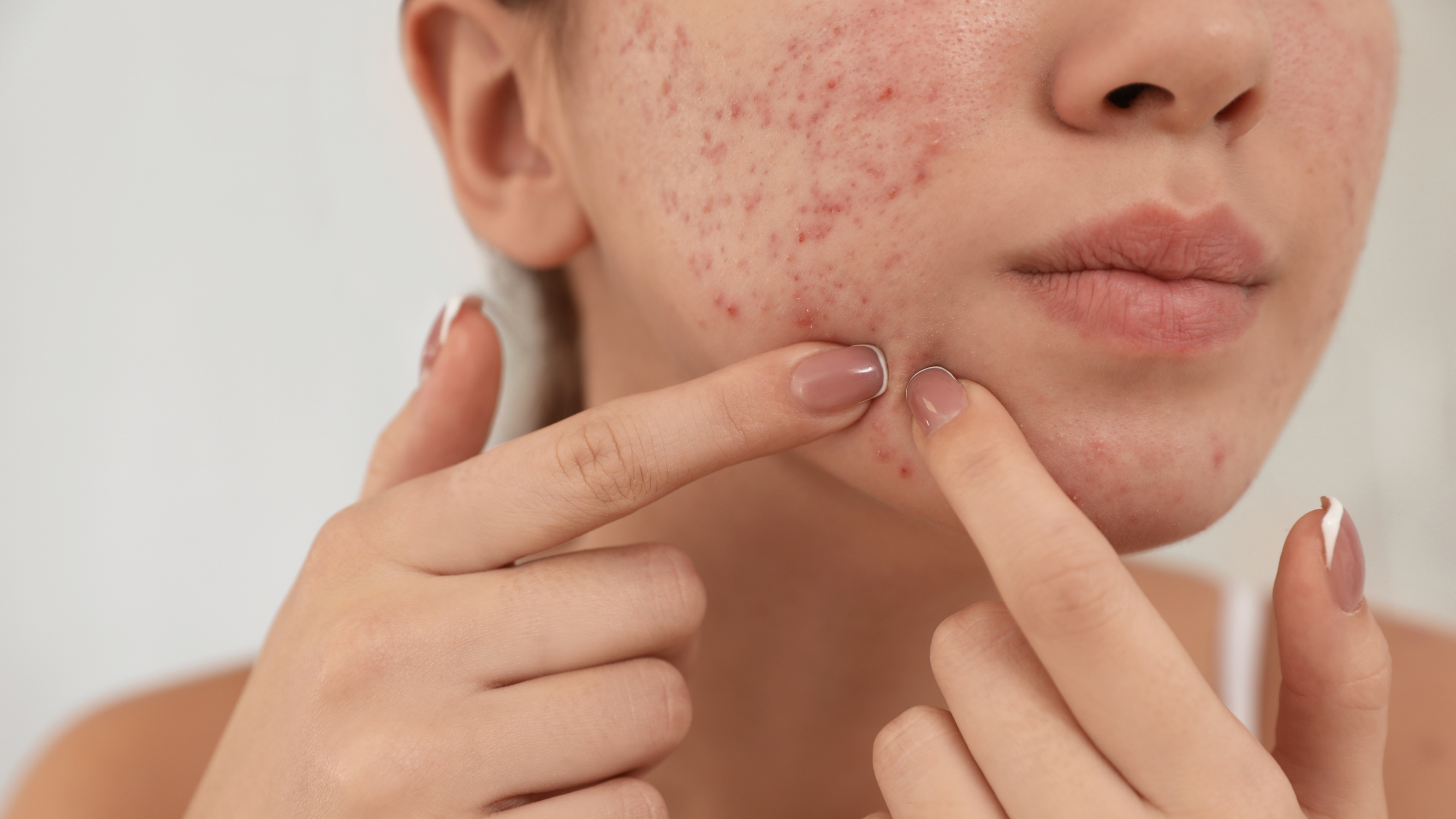 SOS Acne Solution Tips to Calm Acne Fast  Acne Prone Skin