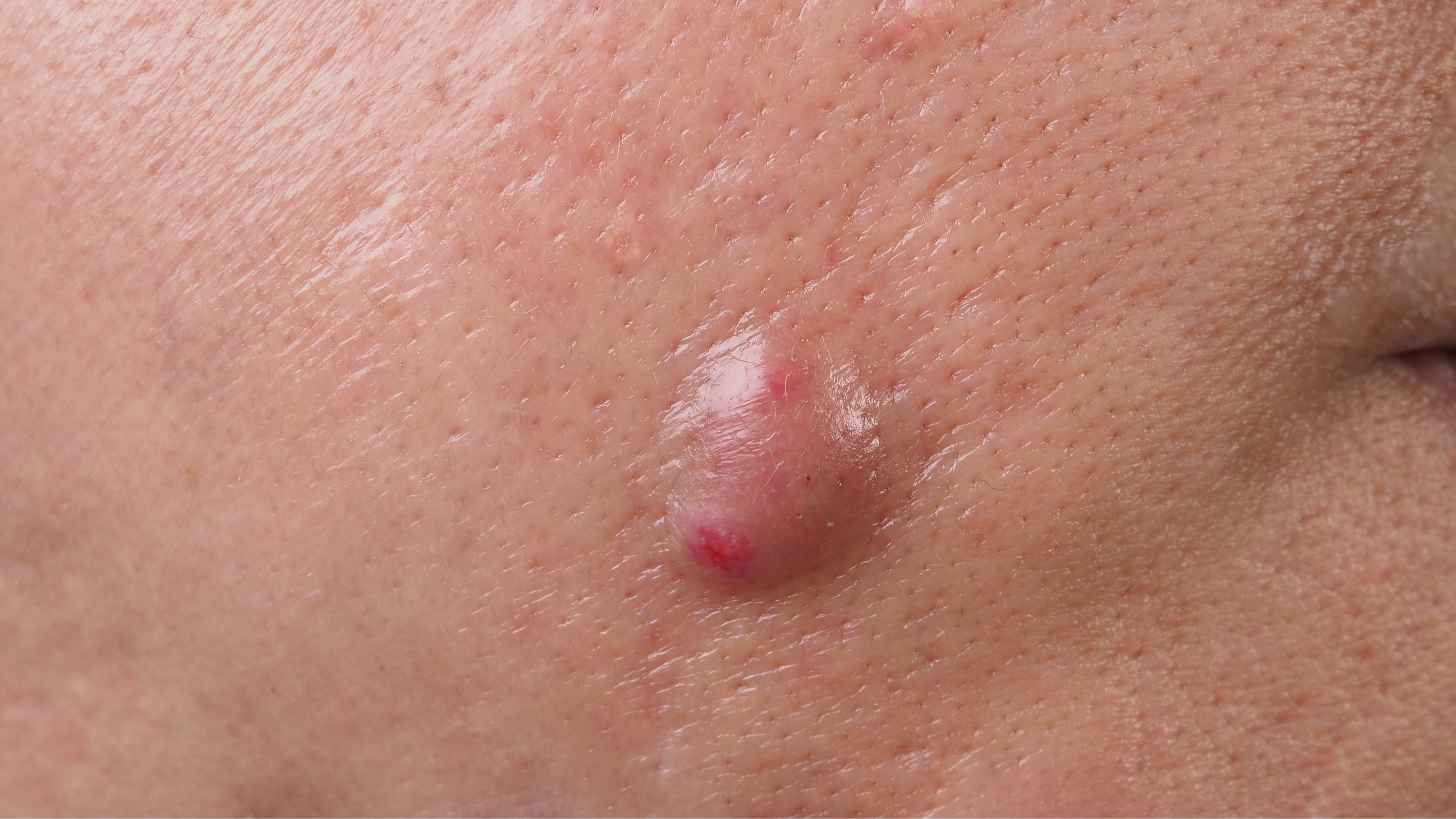 Nodules Acne Healez