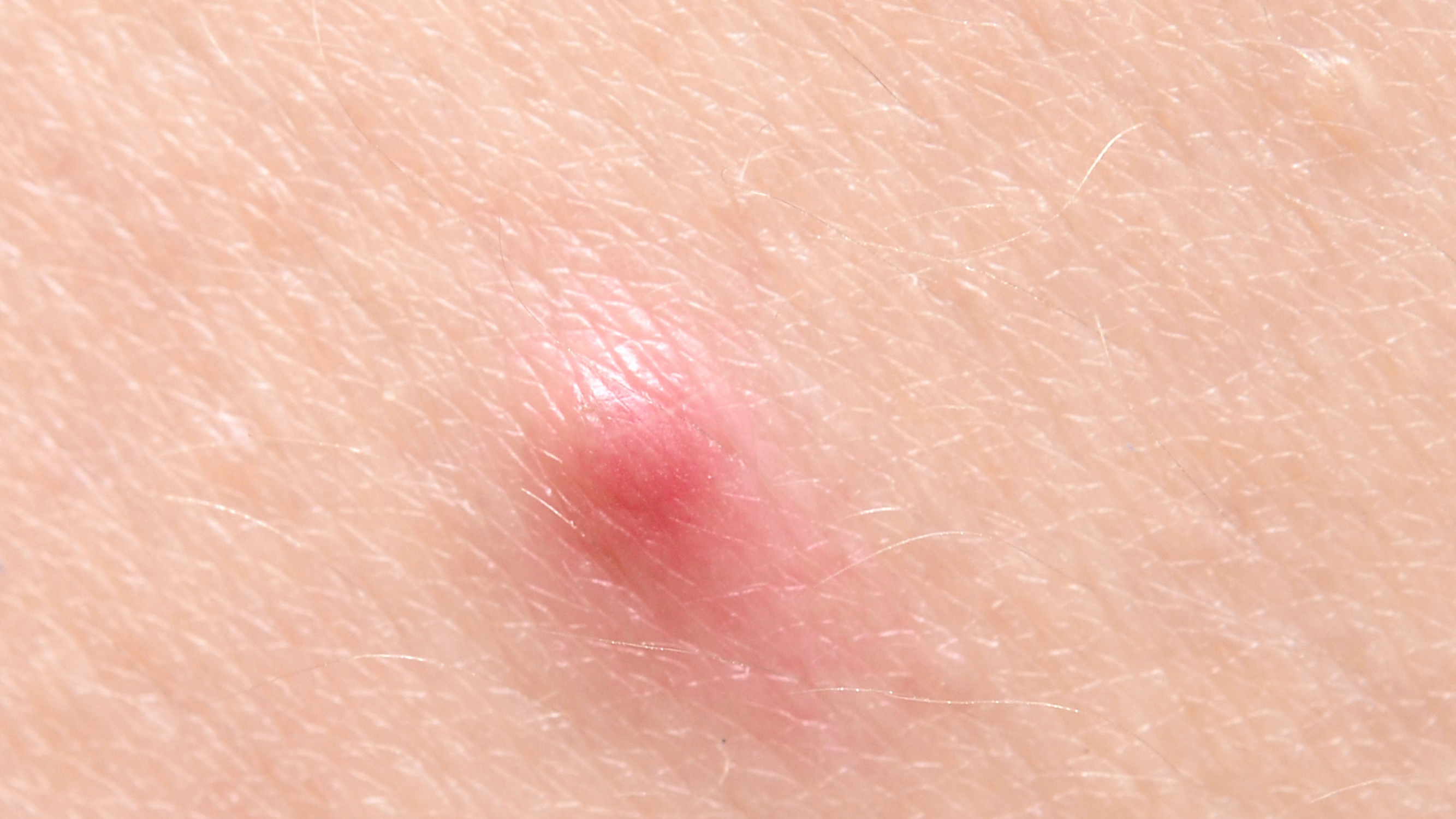 Papules Acne Healez