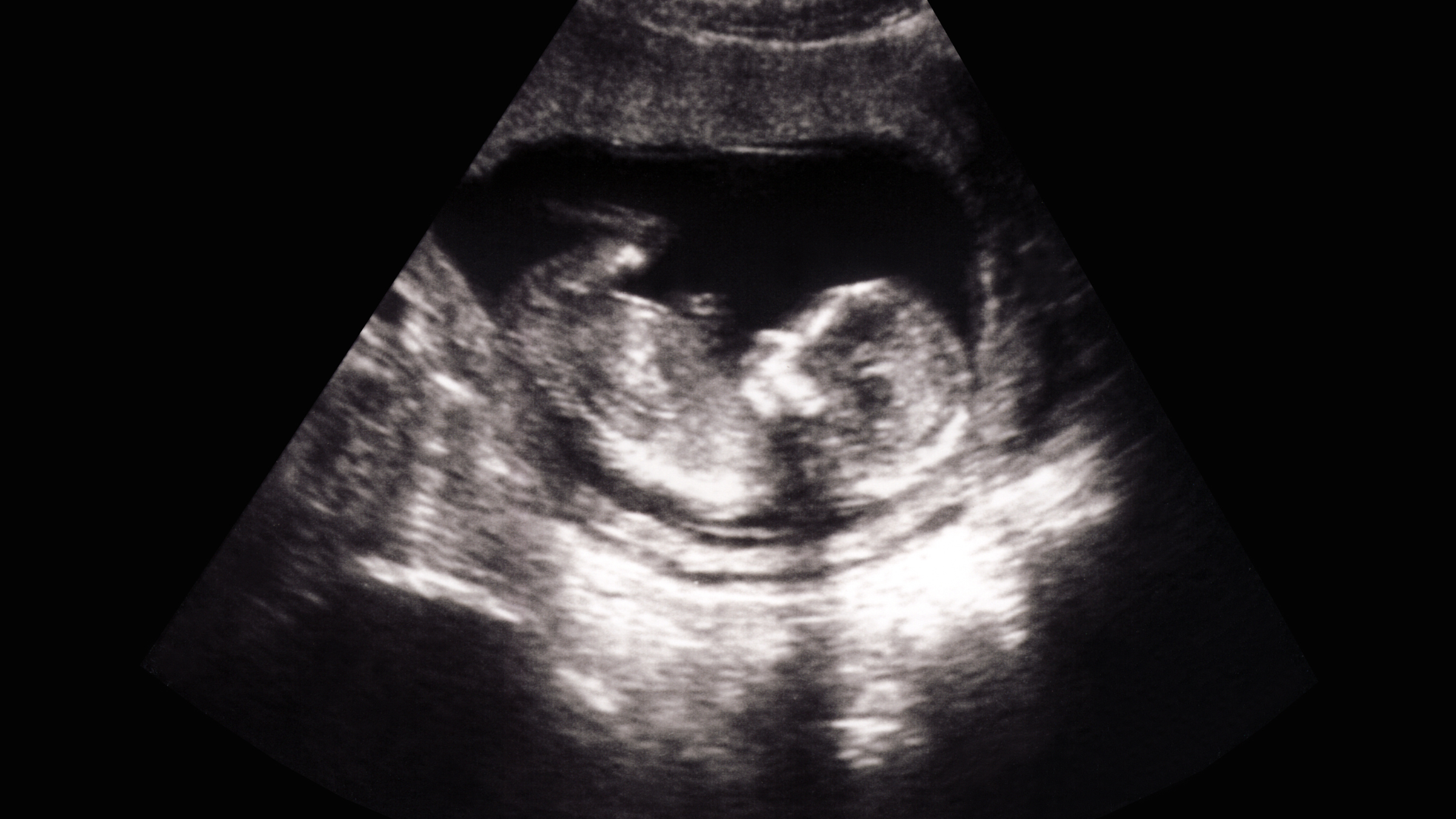 Ultrasound Baby