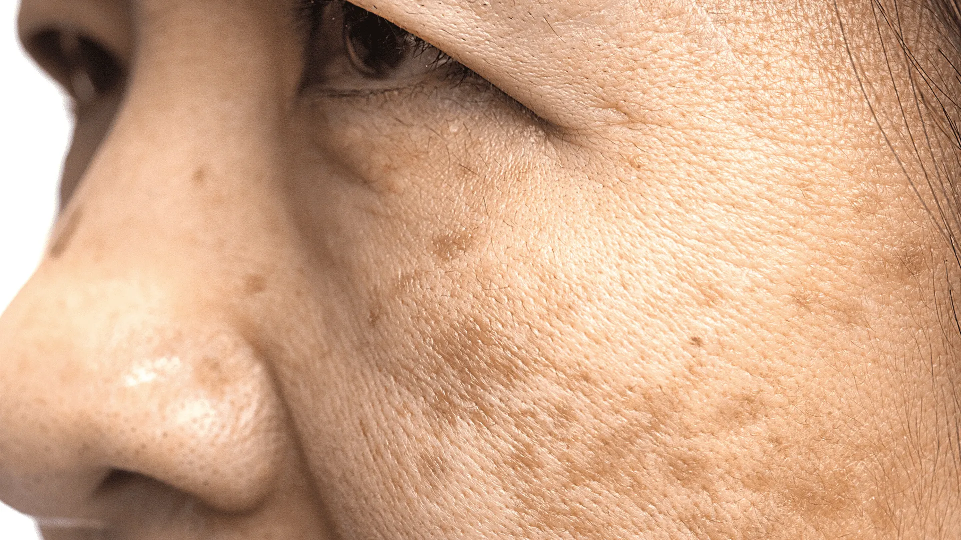 Skin Darkening After Whitening? A Dermatologist’s Fix