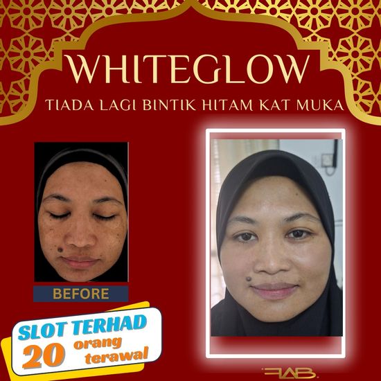 GLOW SAKAN RAYA NI JOM | FAB MEDISPA