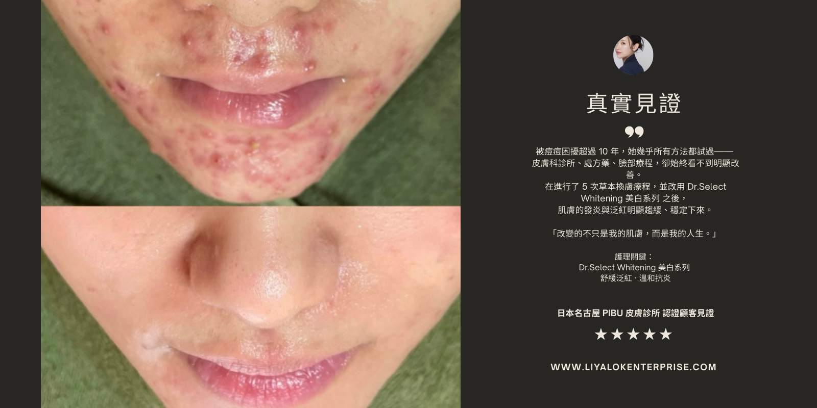 Dr.Select Whitening 痘痘肌前後對比見證