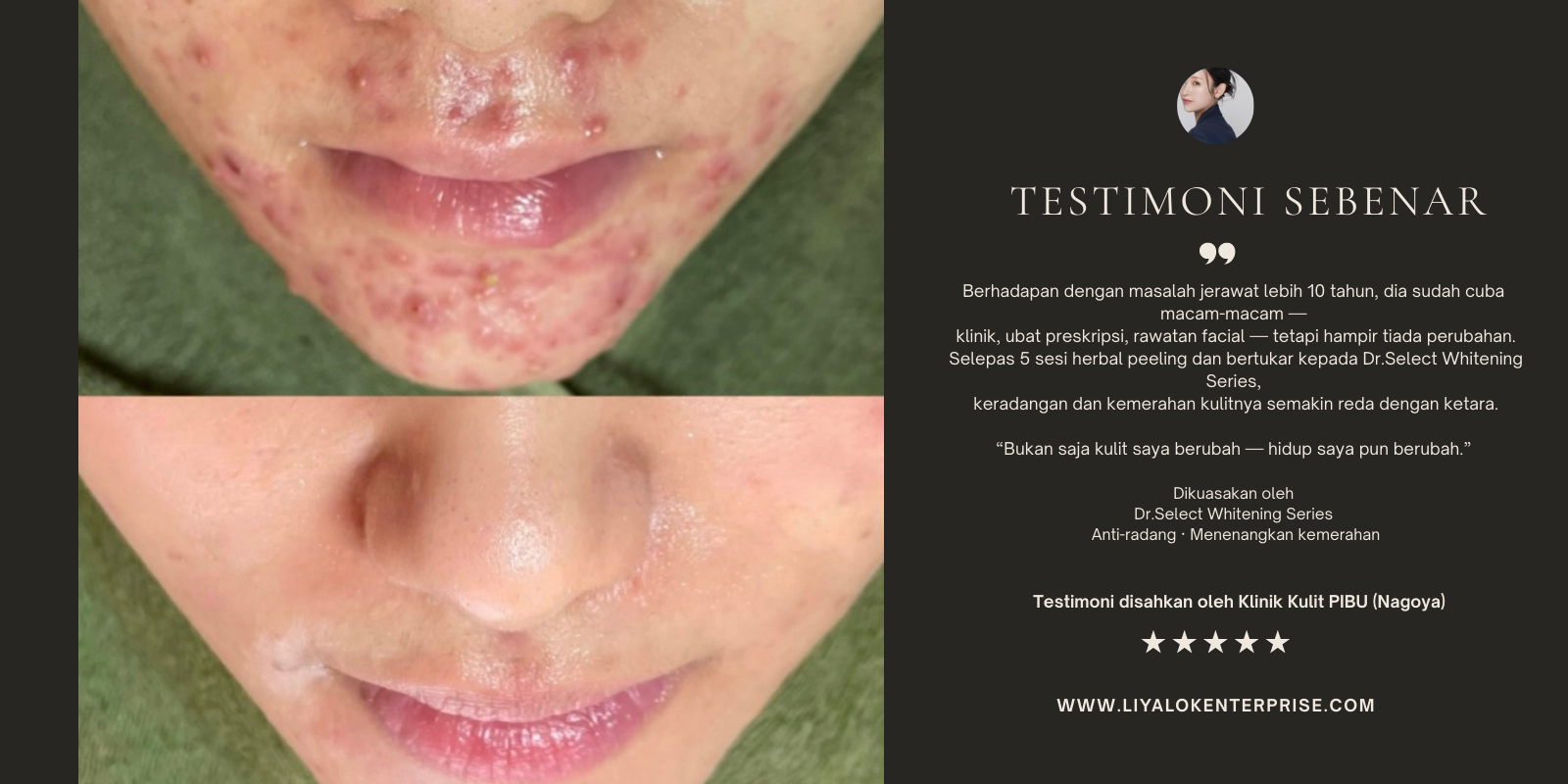 Dr.Select Whitening testimoni jerawat sebelum selepas