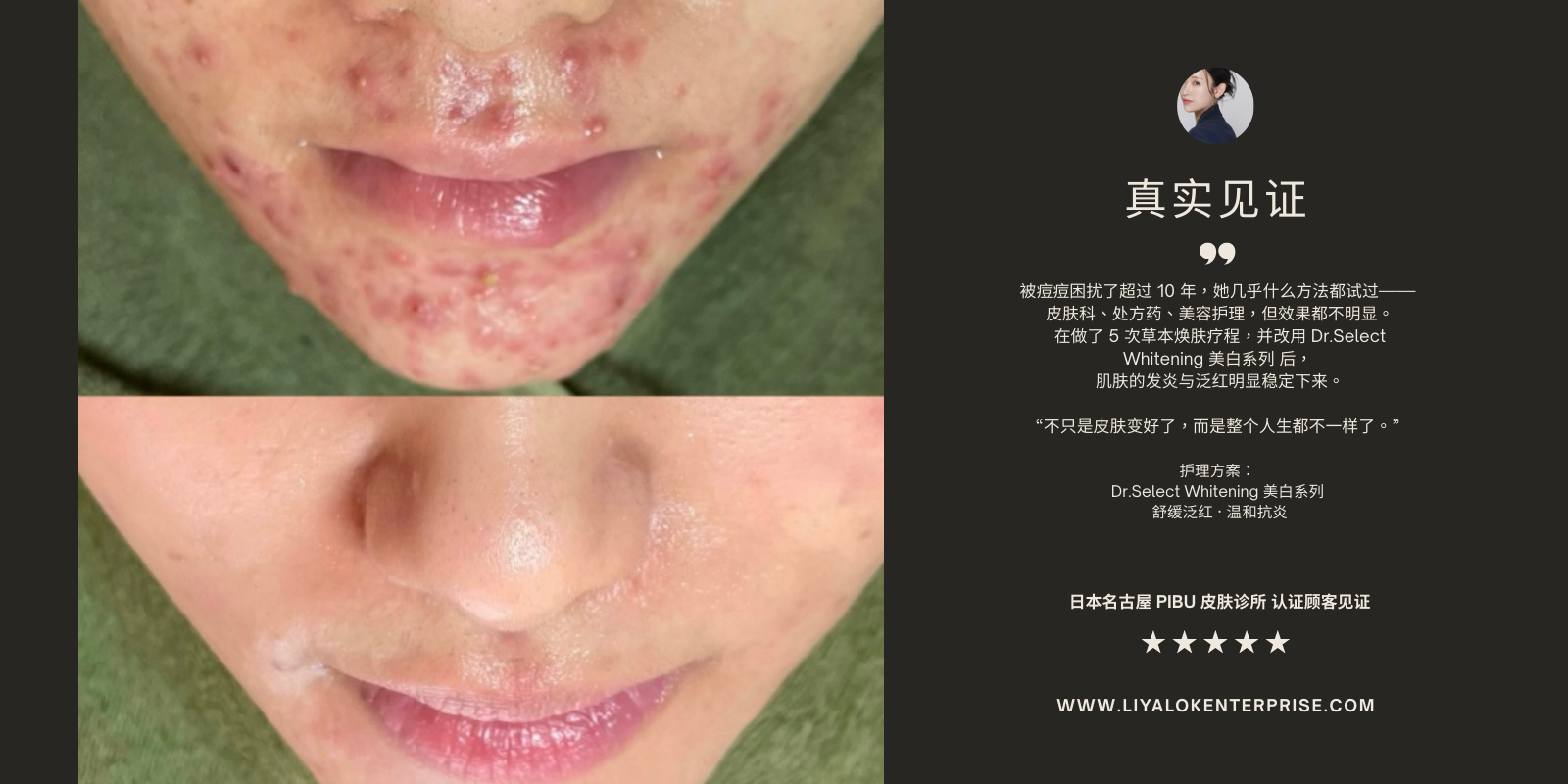 Dr.Select Whitening 痘痘肌前后对比见证