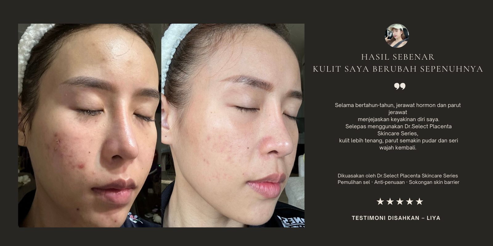 Dr.Select Placenta penjagaan kulit testimoni sebelum selepas