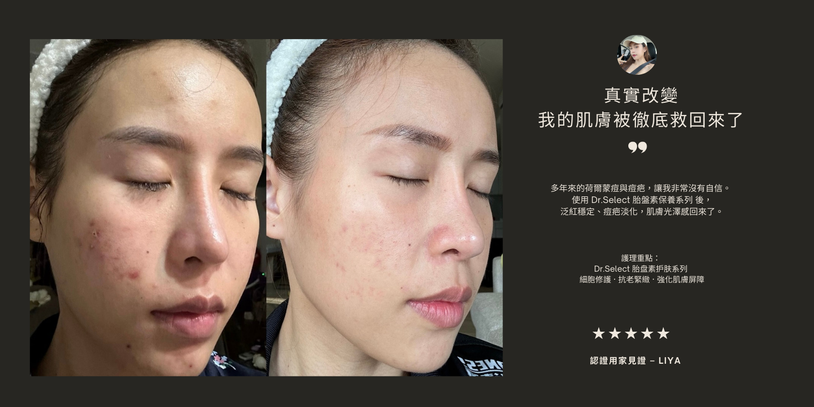 Dr.Select 胎盤素護膚系列前後對比見證