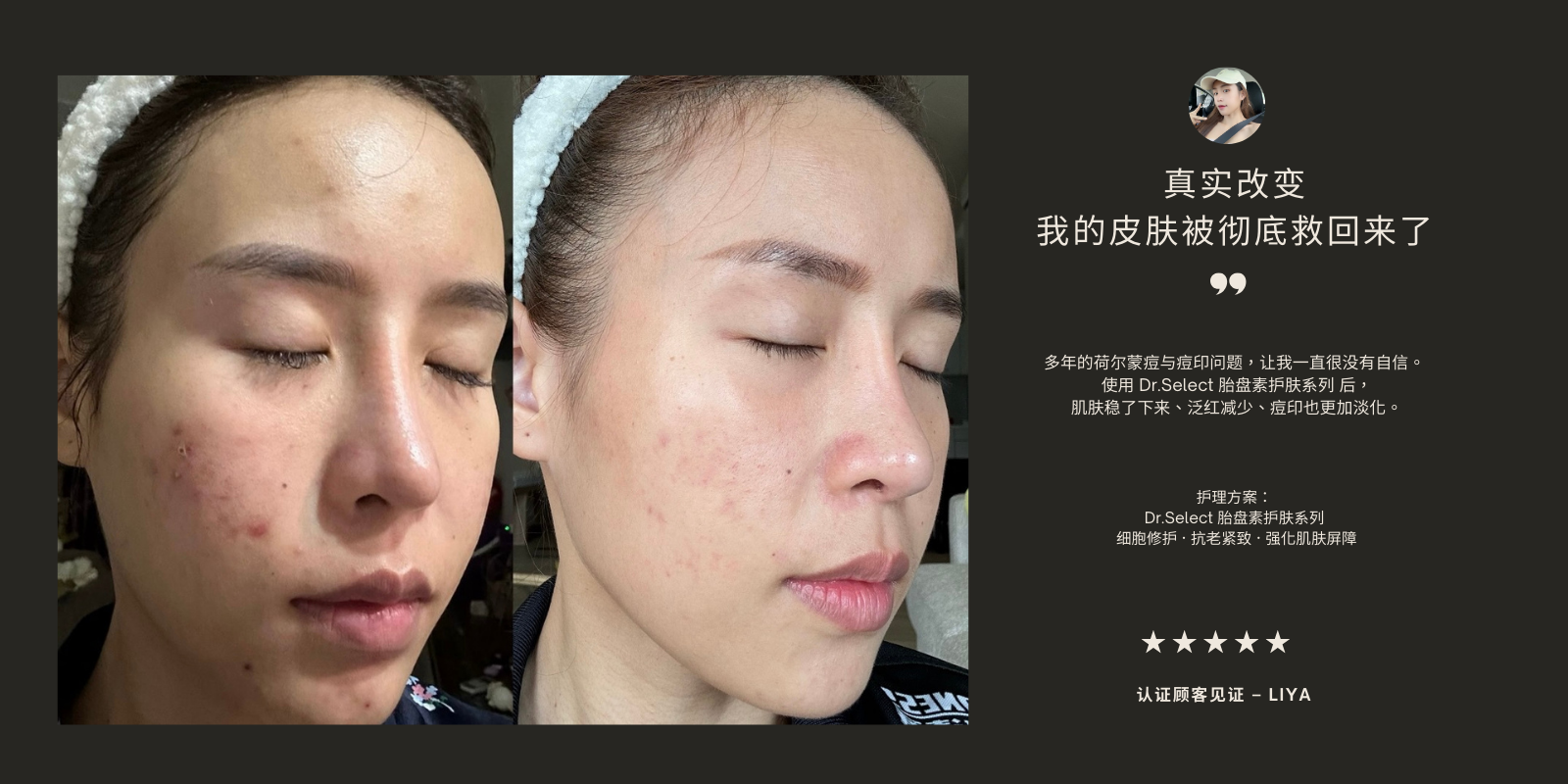 Dr.Select 胎盘素护肤系列前后对比见证