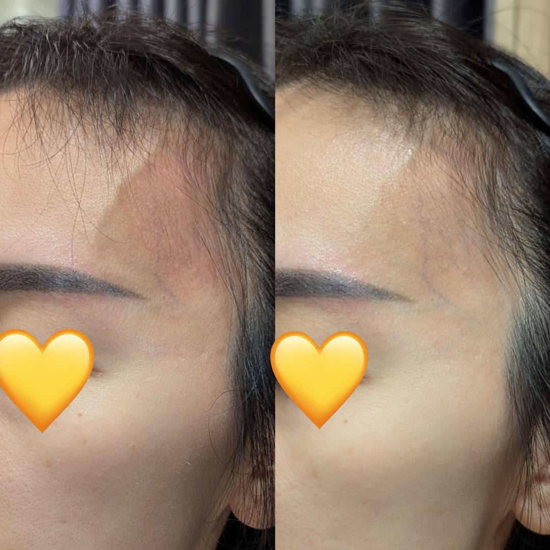 NAD+ OPC 改善静脉曲张与面部轮廓