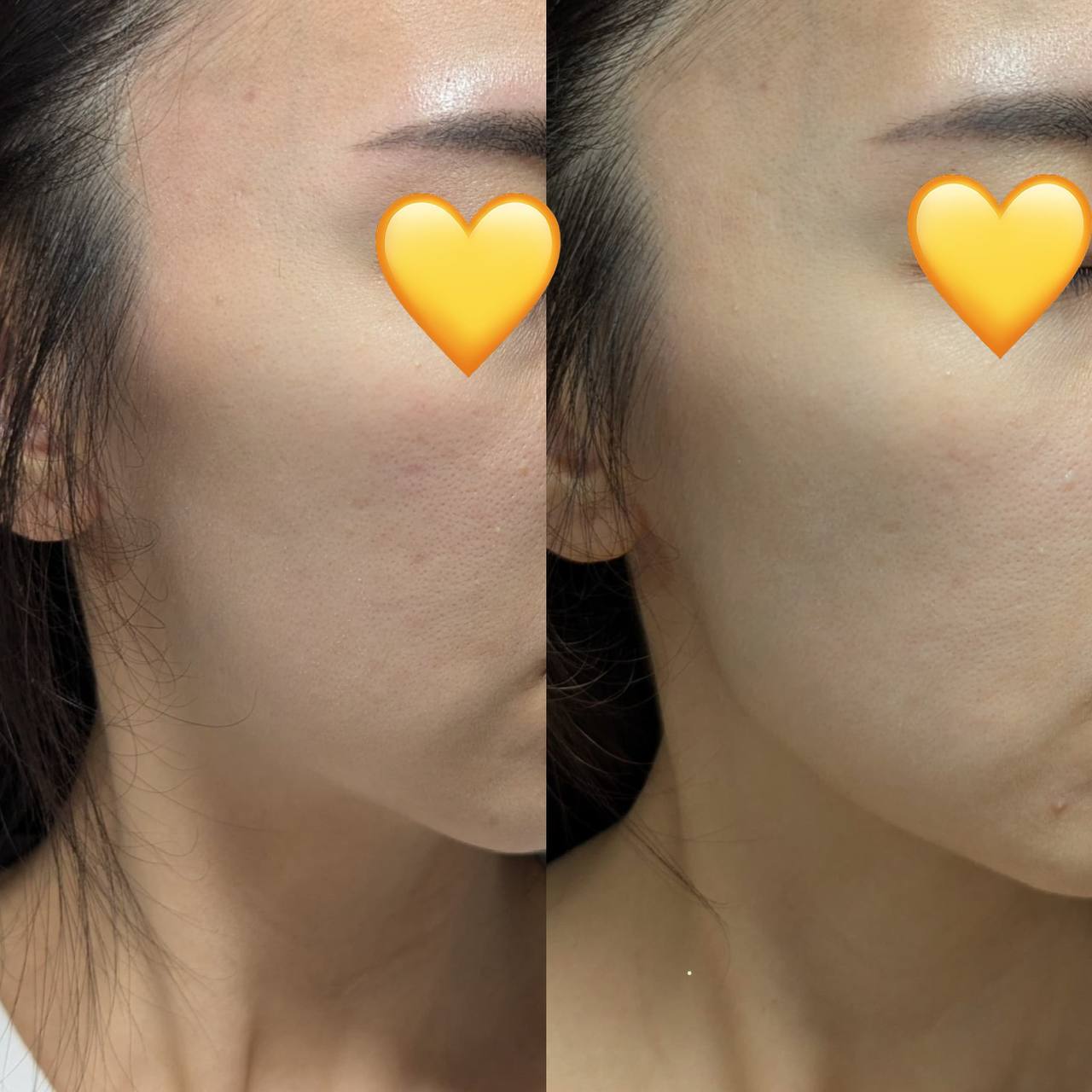 [CN] 2周逆龄奇迹：顾客亲证 NAD+ & OPC 如何“雕刻”出清晰下颚线！🔥