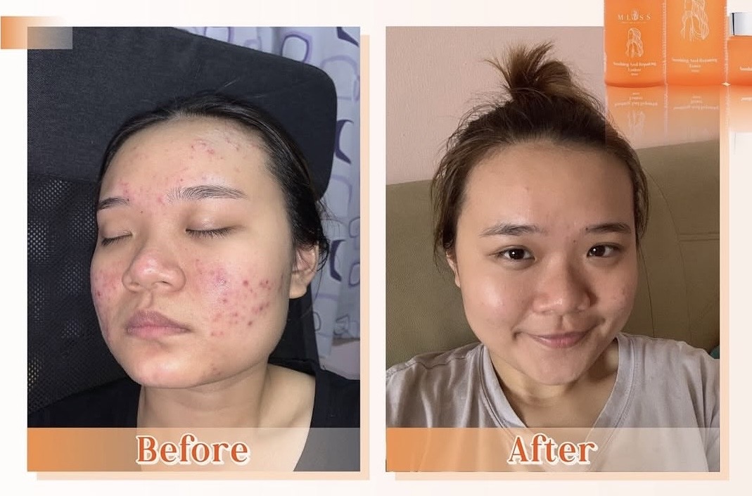 MLISS Skincare Results Before & After