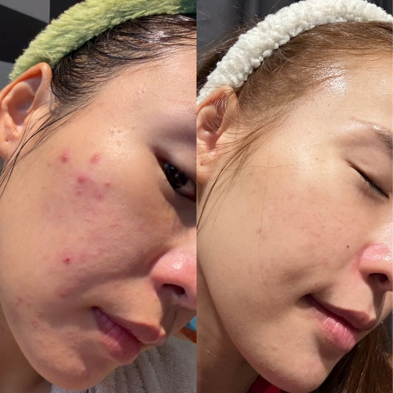 Liya'S 品牌創辦人 Liya Lok 保養修護見證 - MLISS 醫美級敏弱肌退紅與水光提亮
