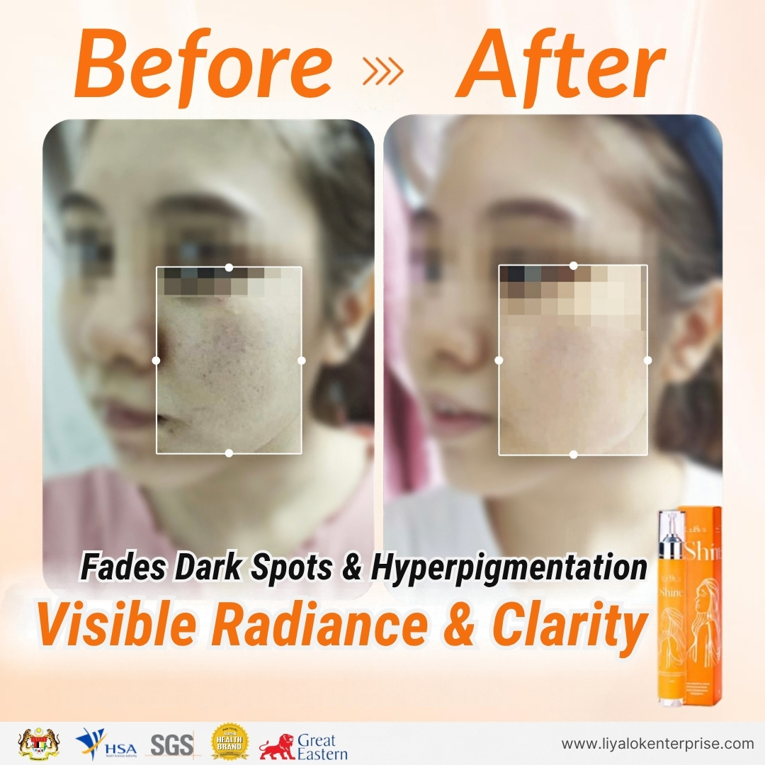 MLISS Shine 2.0 Hyaluronic Acid Essence before and after results for fading dark spots and brightening dull skin