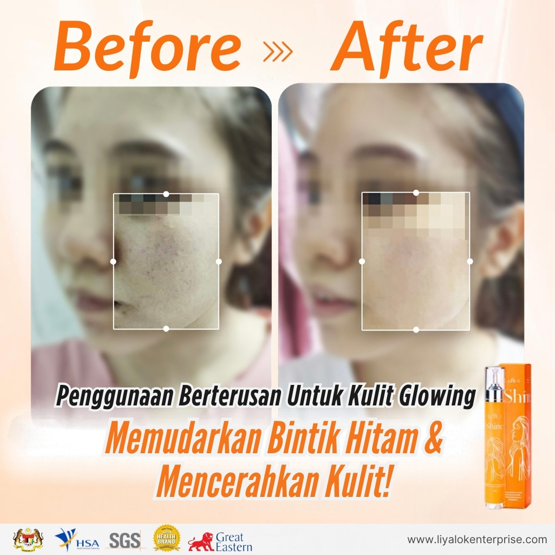 Keputusan sebelum dan selepas MLISS Shine 2.0 Essence: Memudarkan bintik hitam dan mencerahkan kulit