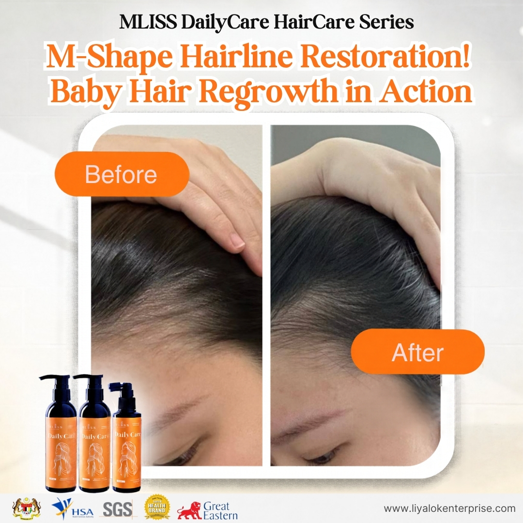MLISS DailyCare Scalp Tonic - M-Shape Hairline Regrowth Baby Hair Before After