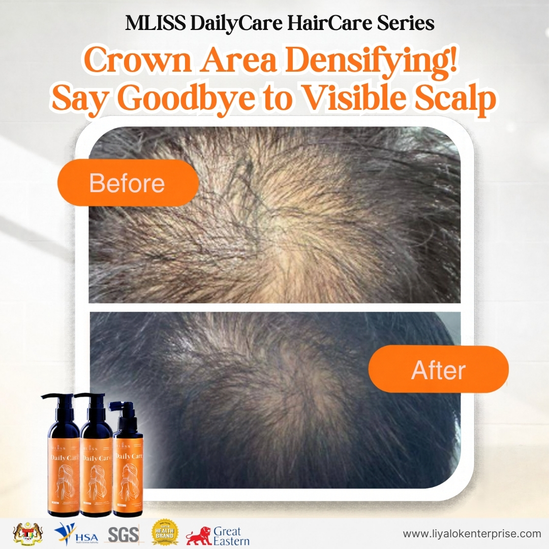 MLISS DailyCare Scalp Tonic - Crown Thinning and Scalp Densifying Before After