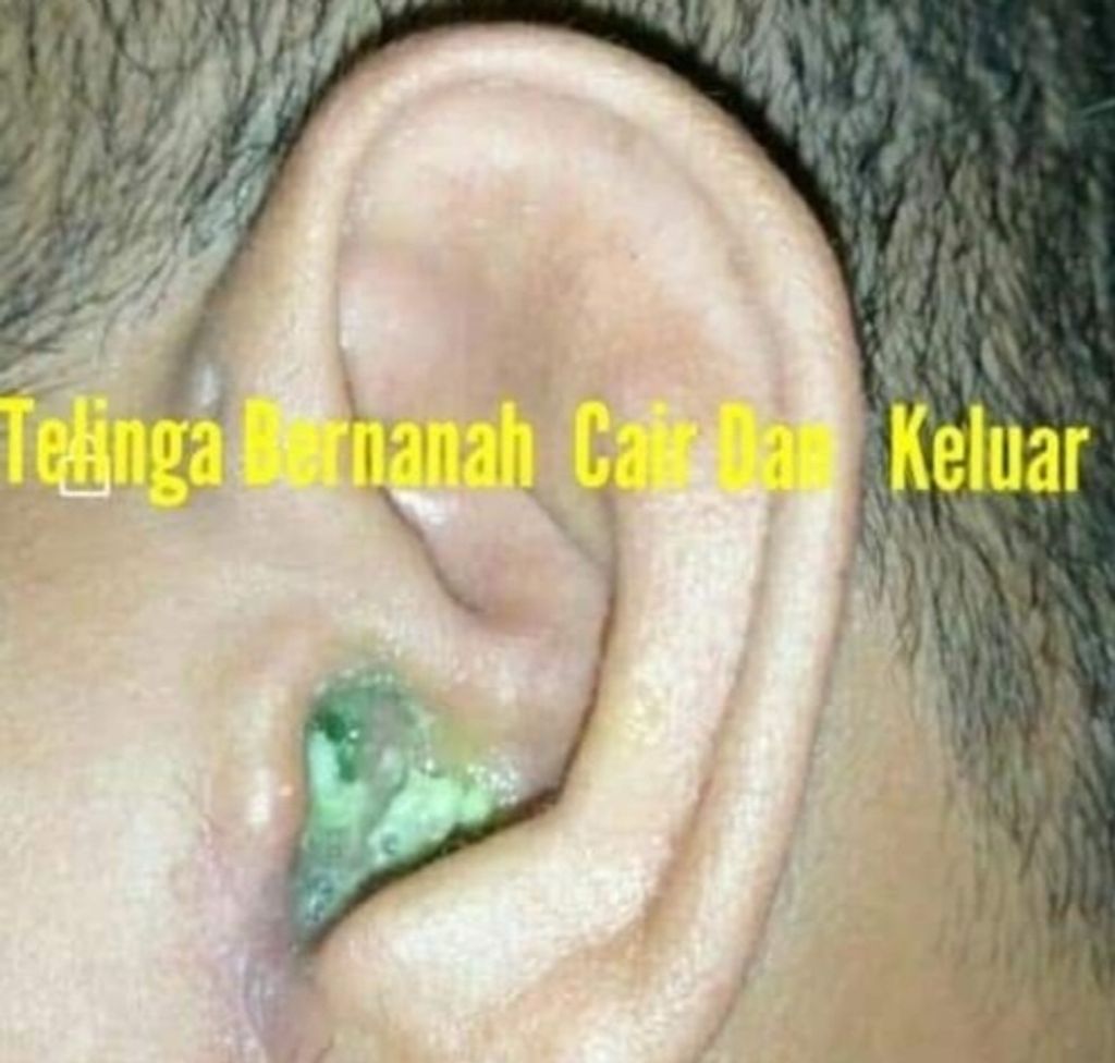 Masalah Telinga Bernanah