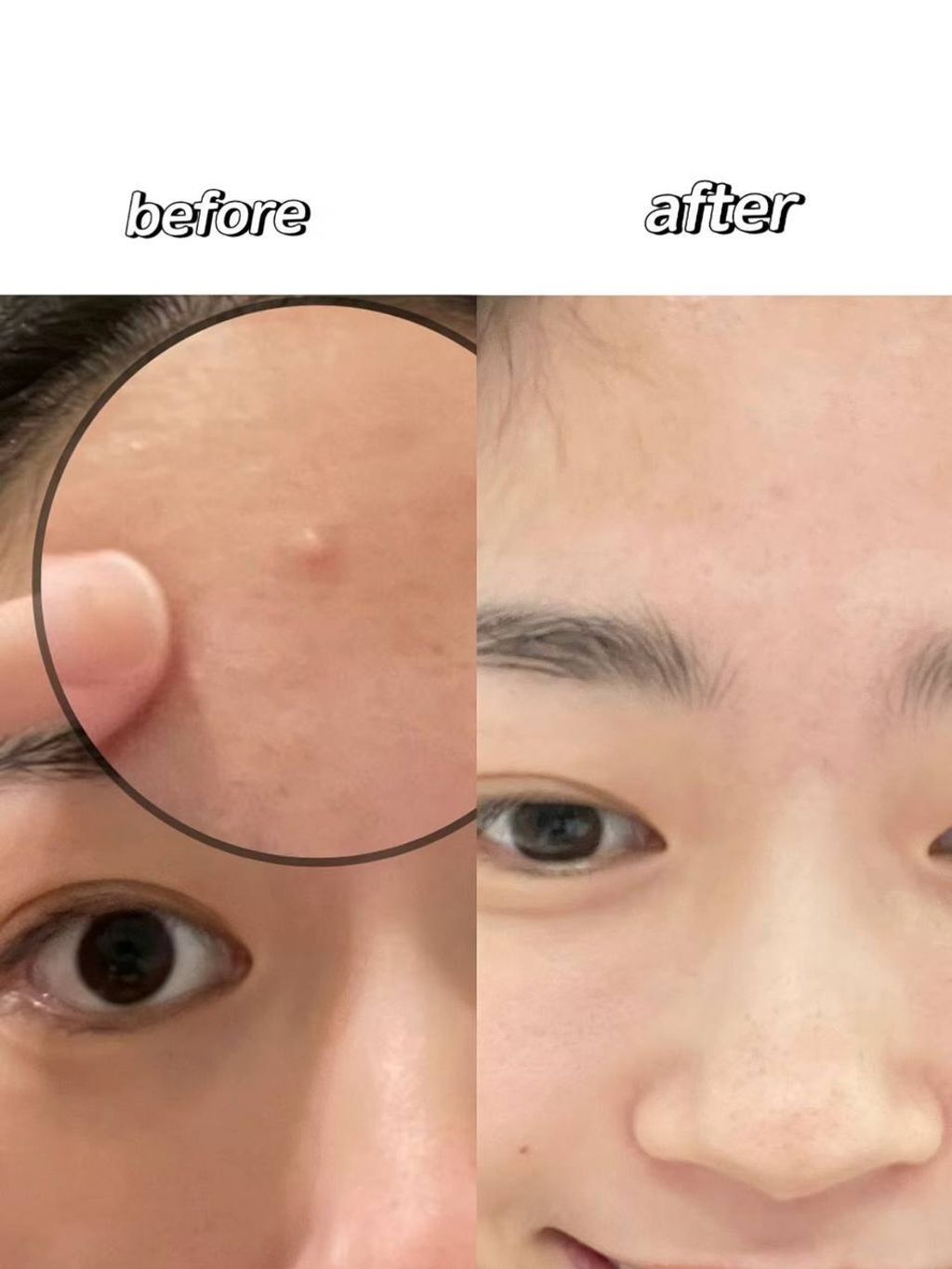 Pair 狮王祛痘膏