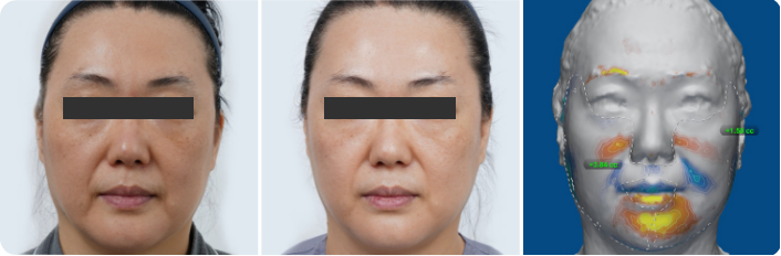 img_web_ufmpt_clinical_before_after_face_v1_001_72dpi