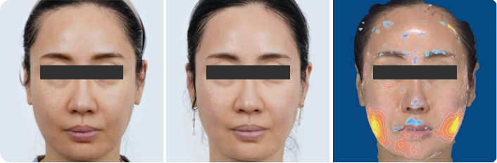 img_web_ufmpt_clinical_before_after_face_v1_002_72dpi-1