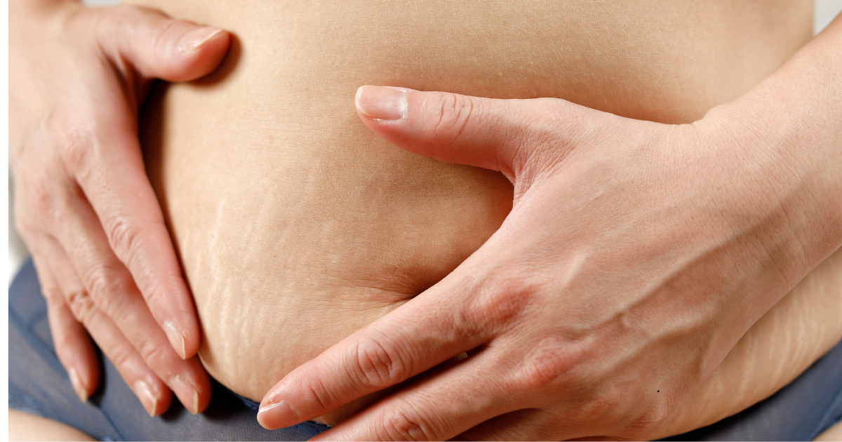 Pregnancy and Stretch Marks: What Expecting Mothers Should Know