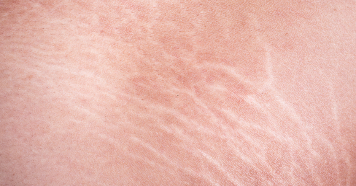 Top 5 Treatments for Stretch Mark Removal: What Works?