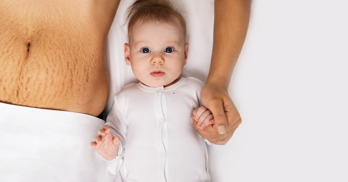 Understanding Stretch Marks: Causes and Prevention Tips