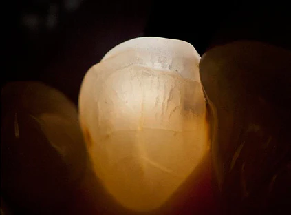 Microlux 2 Transilluminator Revealing Anterior Fractures