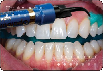 dual whitening step 2