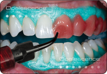 dual whitening step 3