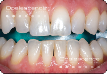 dual whitening step 1