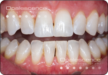 dual whitening step 4