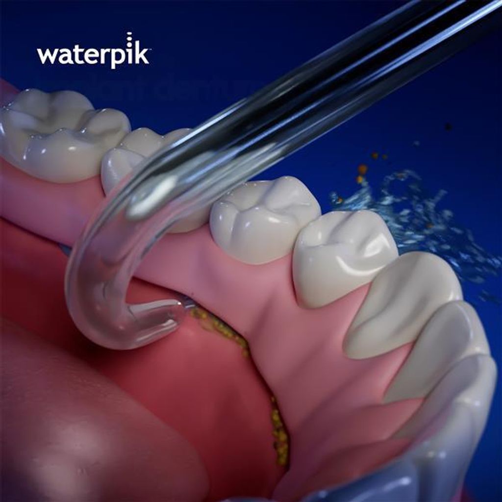 waterpik-implant-tip-lower-arch-dt100e