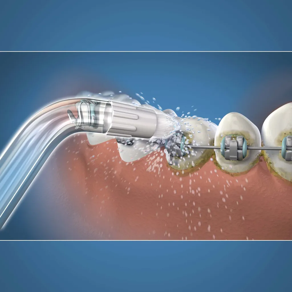 using-orthdontic-tip-od-100e