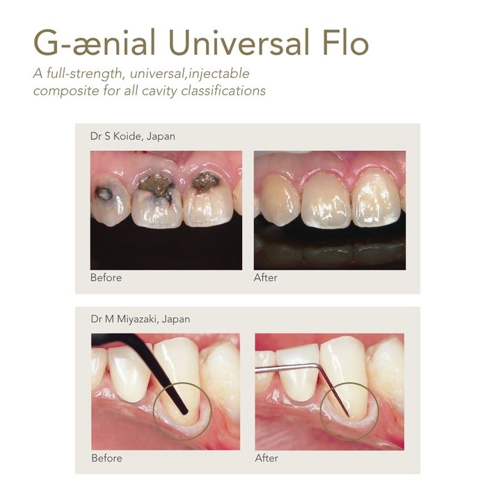 GC G-Aenial Universal Flo 2