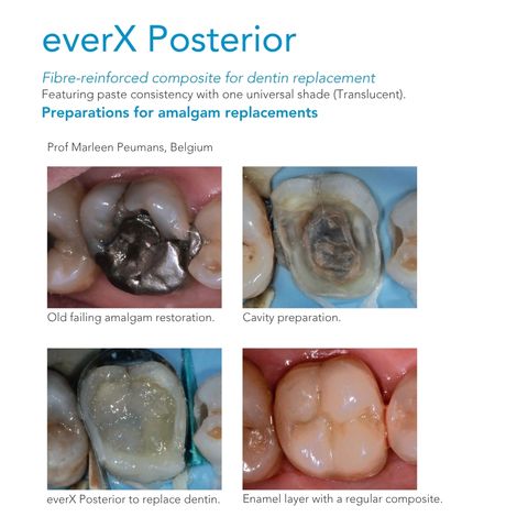 GC everX Posterior 2