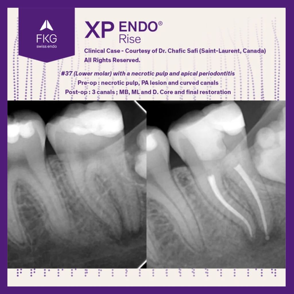 FKG XP-Endo Rise 6